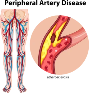 treatment for leg cramps Nevada